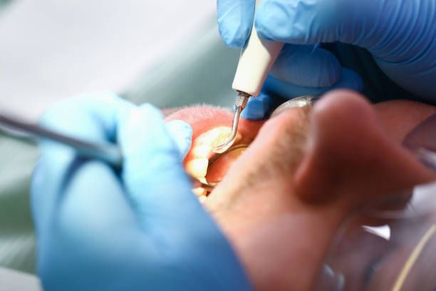 Best Emergency Root Canal Treatment in White City, OR