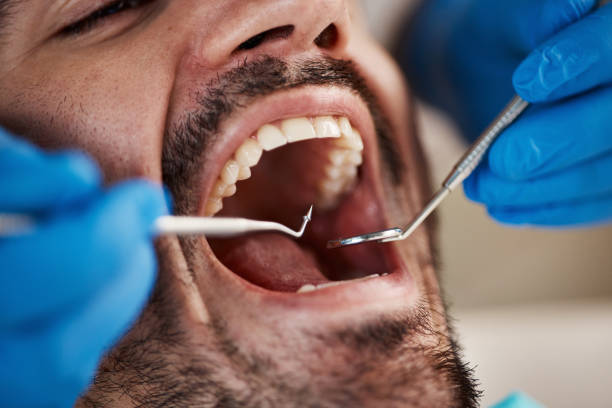 Best Emergency Tooth Extraction in White City, OR